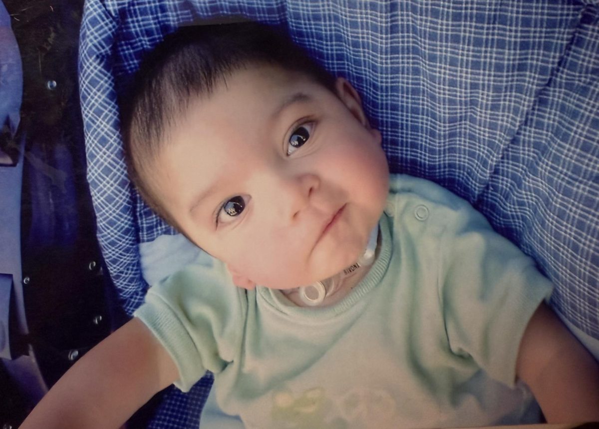 Jet Bautista early In his life after being born with Goldenhar Syndrome
